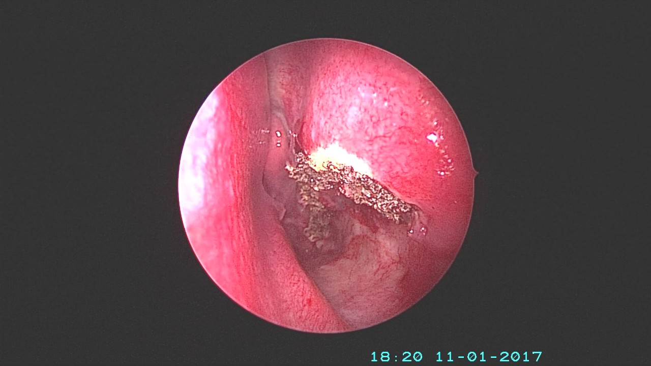 Septoplasty Turbinectomy Youtube