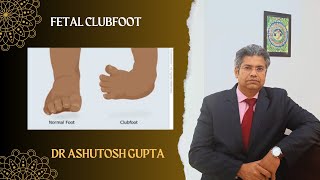 Fetal Clubfoot – Counselling screenshot 3