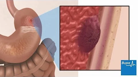 How a peptic ulcer develops - DayDayNews