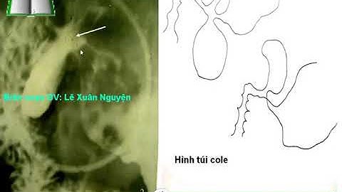 X quang tiêu hóa - chẩn đoán bệnh qua phim x quang