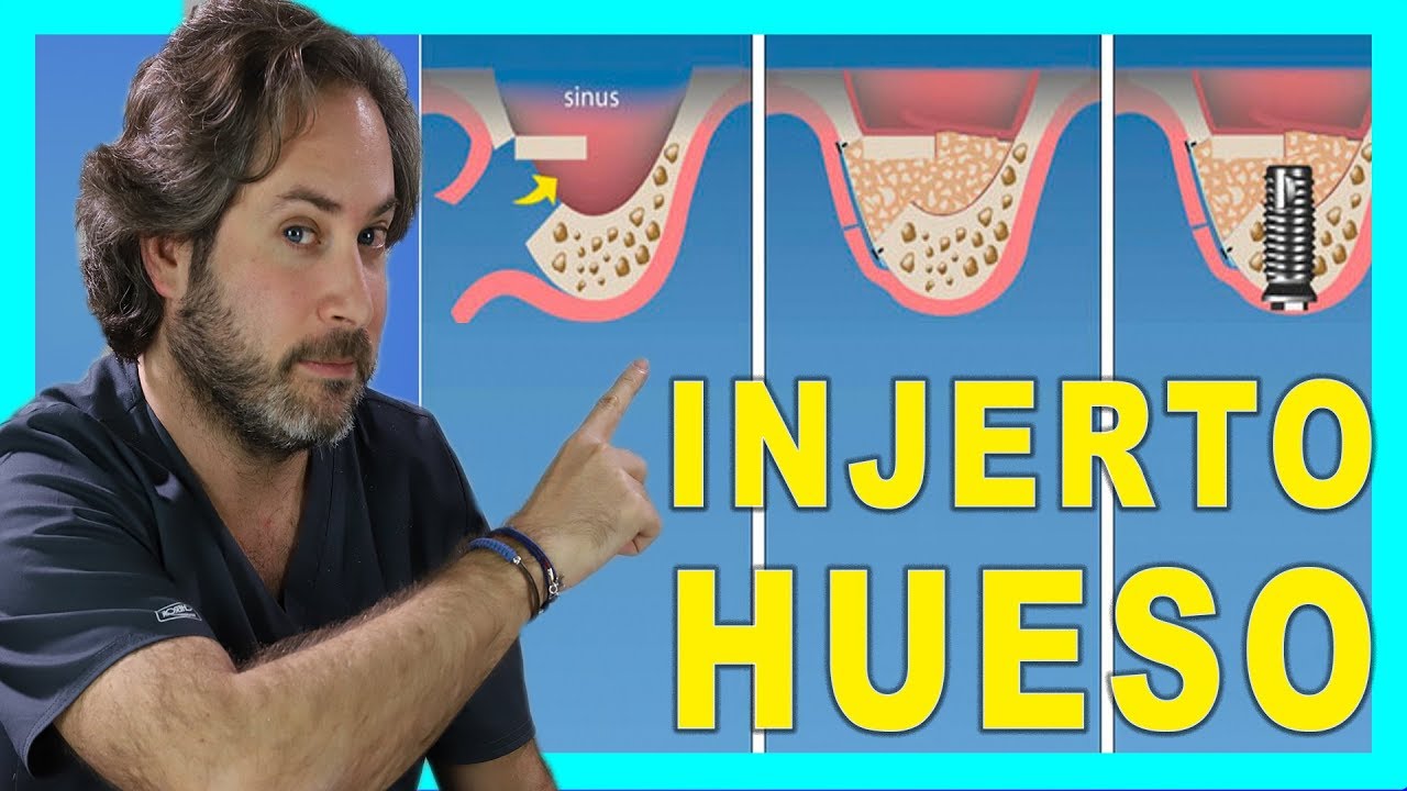 👉🏻ELEVACION DE SENO maxilar ATRAUMATICA👈🏻 Injerto de HUESO para