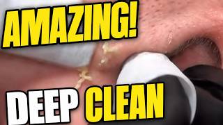 Deep Pore Cleaning: Watch This Satisfying Skin Transformation!
