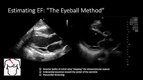 Assessing LVEF with POCUS | Quick, Reliable Bedside Cardiac Function