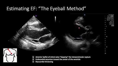 Assessing LVEF with POCUS | Quick, Reliable Bedside Cardiac Function