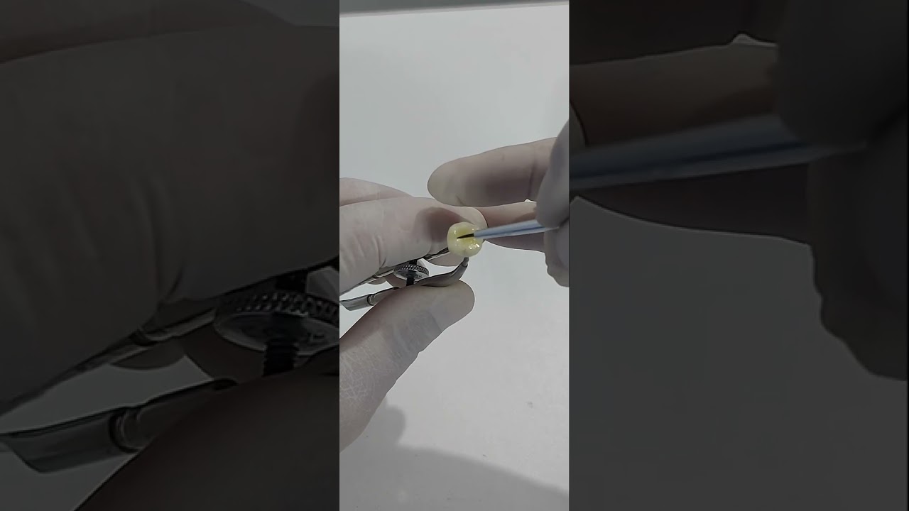 Maquiagem de uma Coroa de Resina Impressa em 3D.