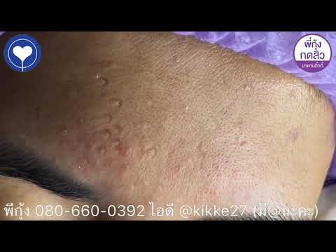 Remover of Blackheads & Whiteheads Easy-CYSTIC ACNE ON FACE # Millia