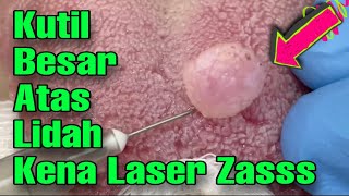 LASER KUTIL BESAR ATAS LIDAH - @DrManTtdi