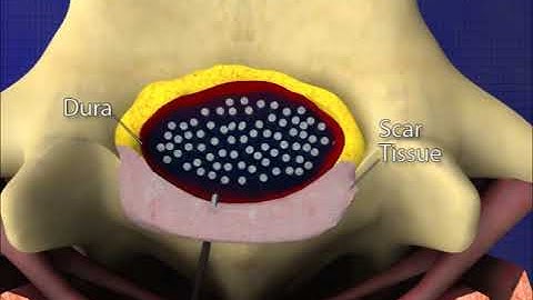 Subdural Injection Trial Animation