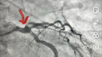 When wiring the vessel becomes the Real Challenge in an ‘Easy’ PCI!