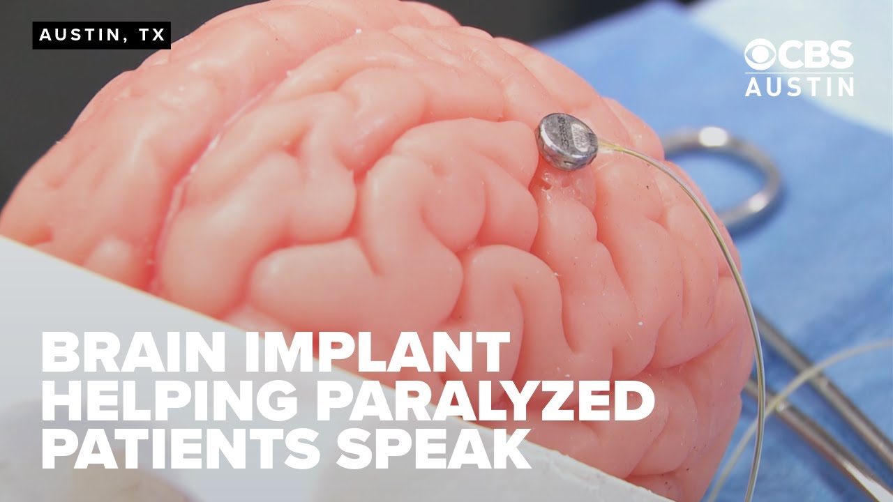 Austin's Paradromics advances Brain-Computer Interface with successful surgery