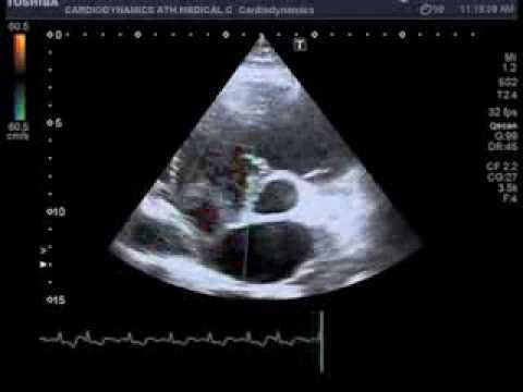 What is an atrial septal aneurysm?