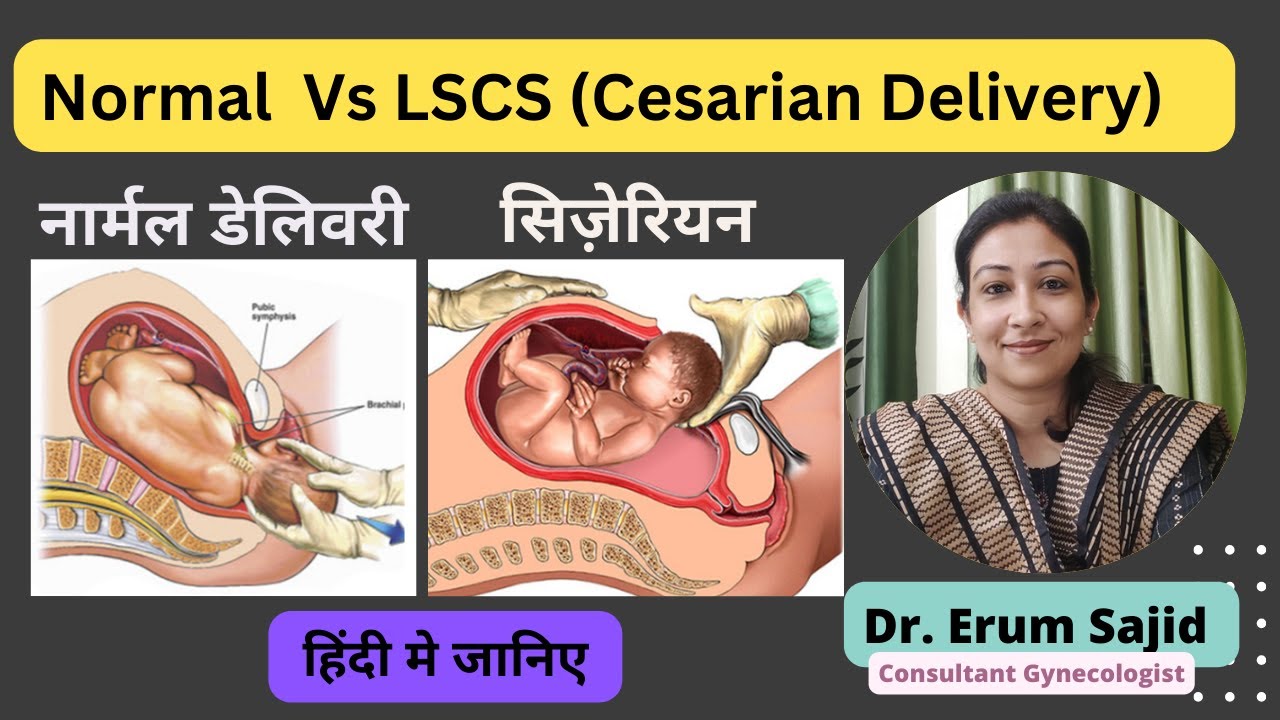 Normal Delivery V/s LSCS (Cesarian) | Dr Erum Sajid Clinic Best ...