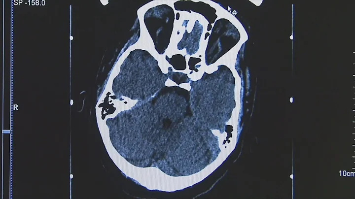 Study explores potential benefits of deep brain stimulation in stroke recovery