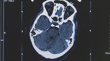 Study explores potential benefits of deep brain stimulation in stroke recovery
