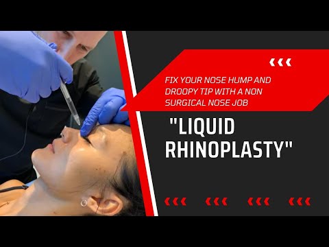 FIX YOUR NOSE HUMP AND DROOPY TIP WITH A NON SURGICAL NOSE JOB "Liquid Rhinoplasty" | Dr. Jason Emer