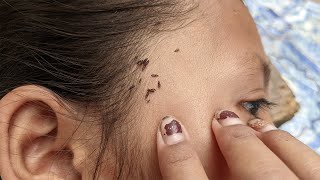 How to pick a lot of head lice from hair - Getting out million head louse from brown hair