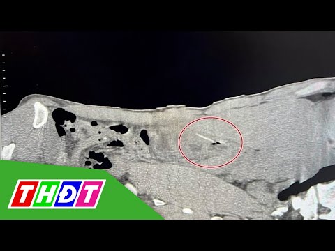 Video Bình Thuận: Nam thanh niên bị tăm xỉa răng đ.â.m thủng... - youtube