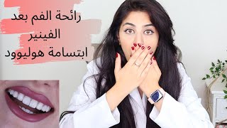 رائحة الفم بعد الفينير / ابتسامة هوليوود