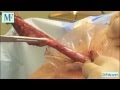 Sleeve Gastrectomy Surgery by Dr. Feiz