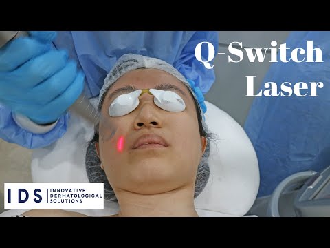 Q Switch Laser Before and After | IDS Clinic Review