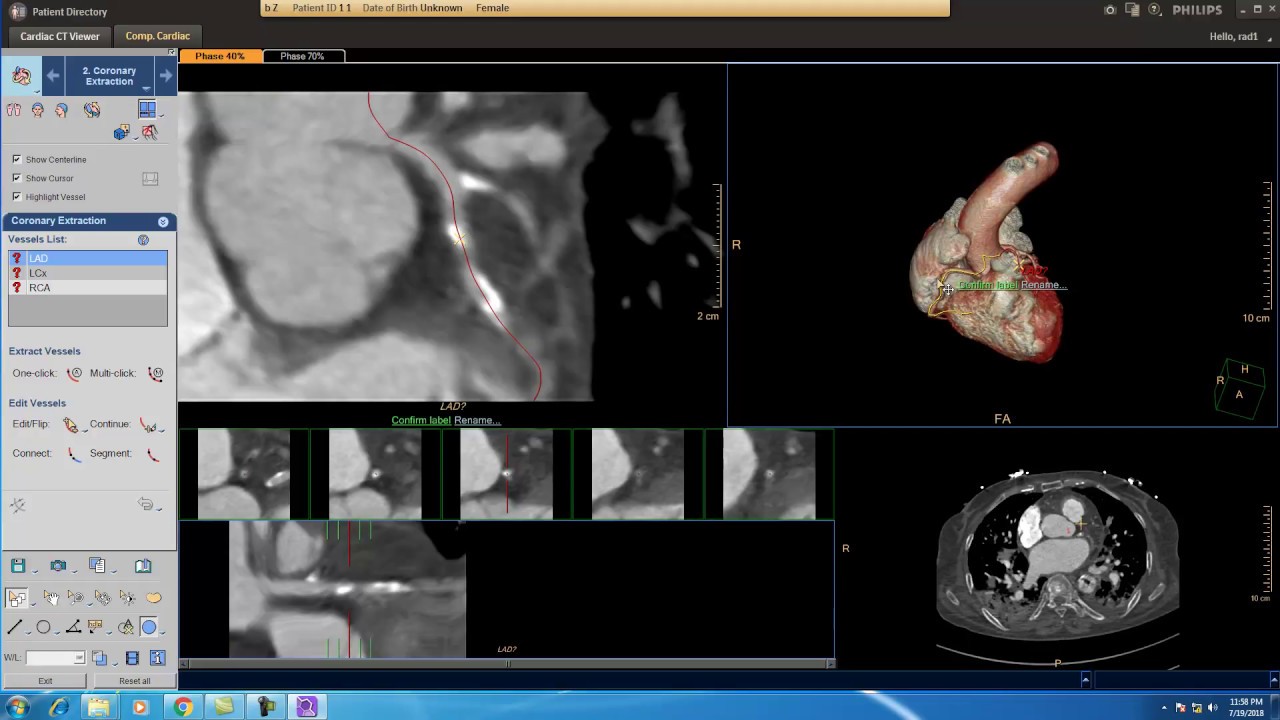 Comprehensive Cardiac of Philips workstations with a triple rule out protocol