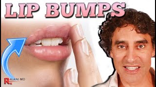 LIP FILLER GONE WRONG // Lip Fillers
