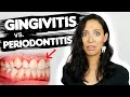 Do You Have Gingivitis or Periodontitis? | Different Stages Of Gum Disease
