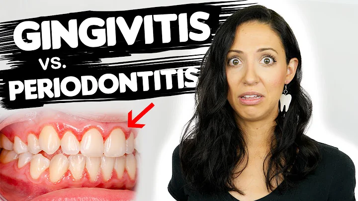 Do You Have Gingivitis or Periodontitis? | Different Stages Of Gum Disease - DayDayNews