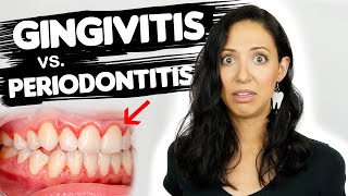 Do You Have Gingivitis or Periodontitis? | Different Stages Of Gum Disease screenshot 5