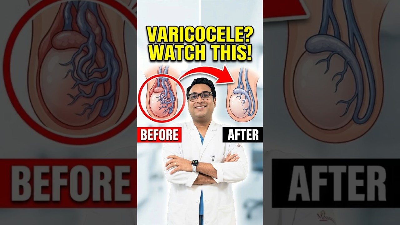 Varicocele Embolization Patient Experience |  Explained by Dr Gaurav #viral