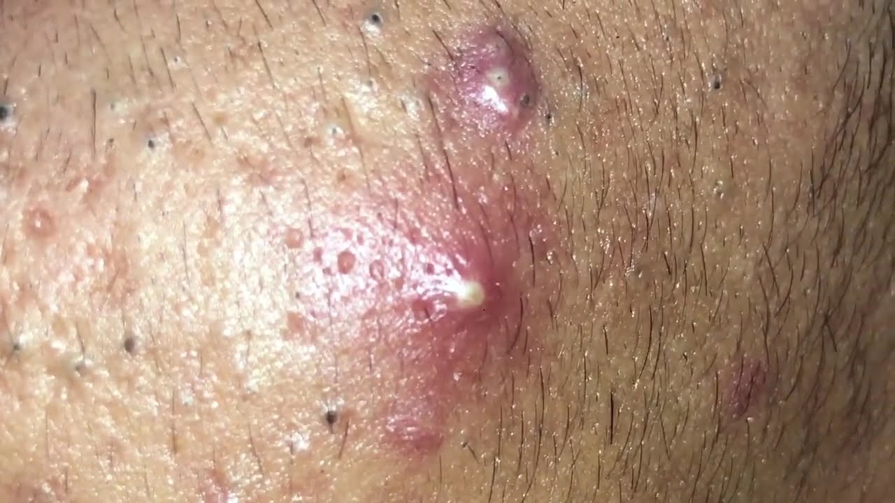 Today Dep Sac Spa Blackheads 2025 new this Week