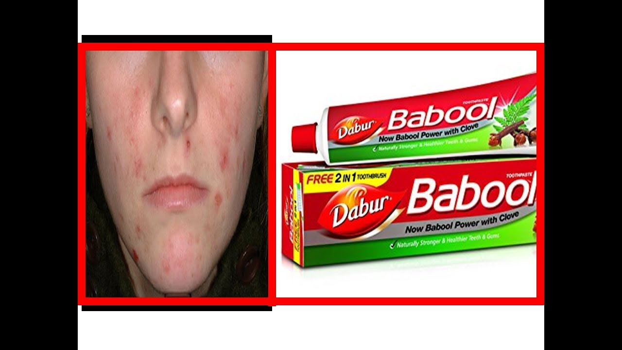 Download कैसे Dabur Babool से 1 दिन में चेहरे से दाग धब्बे, मुँहासे के निशान को गायब करें//Remove Pimples
