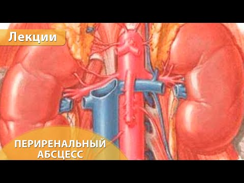 Разбор клинического случая - периренальный абсцесс с забрюшинным распространением. Андрей Мангов