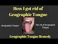 44+ Is There A Cure For Geographic Tongue