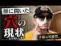 顔の穴の現状について。