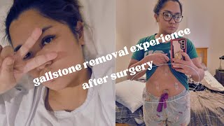 Life after gallbladder removed! What happens after surgery?? My Experience | Millennial Girlfriend What Happens After Your Gallbladder Gets Removed