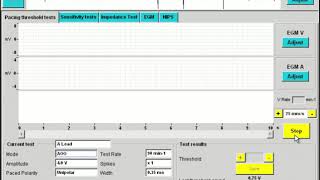 Interrogating a Microport pacemaker | Tests / EGM
