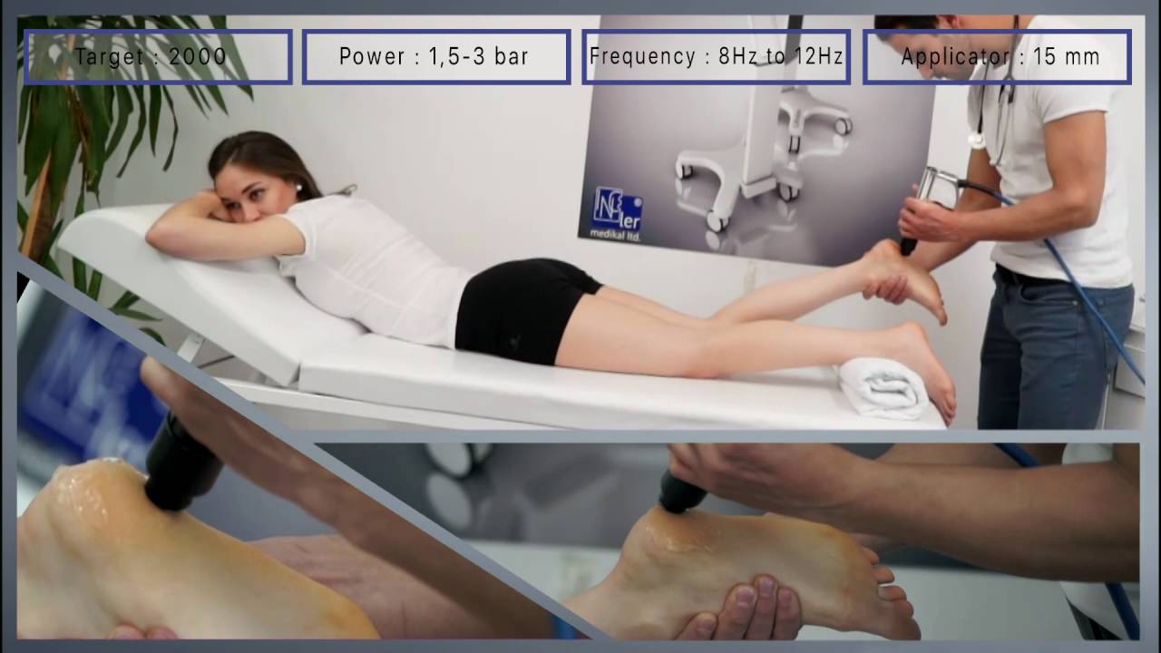 Plantar Fasciitis Treatment by MODUS ESWT Touch