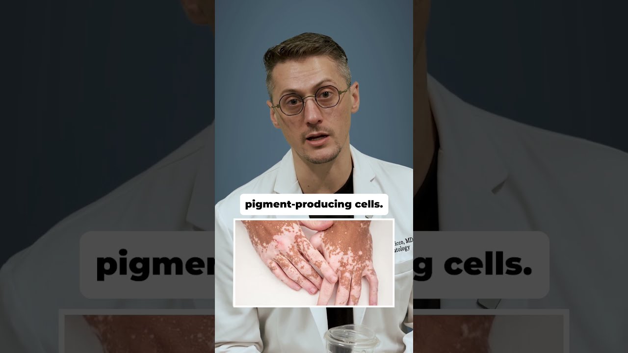 Is Vitiligo Contagious Let S Clear It Up 