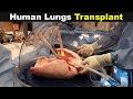 How Does Lung Transplant Works? | Human Lungs Transplant (Urdu/Hindi)