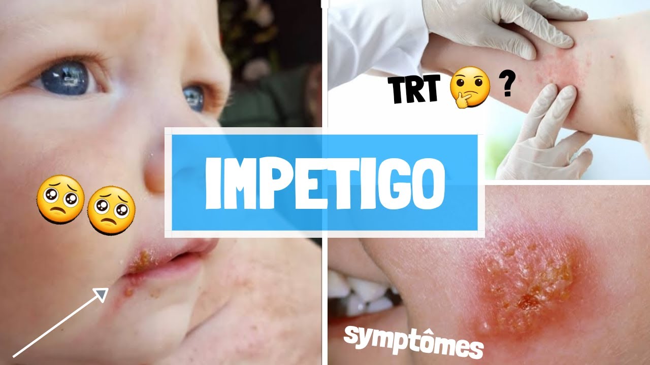 Impetigo Causes Sypmtomes Complications Traitement Youtube