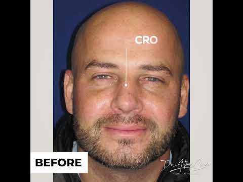 Video thumbnail: Rhinoplasty Testimonial with Improved Breathing · Dr. Anthony Corrado