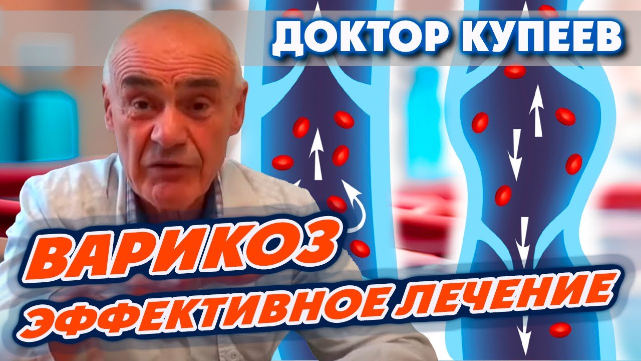Лечение варикоза без операции /Варикоз на ногах лечение /Вылечить ...