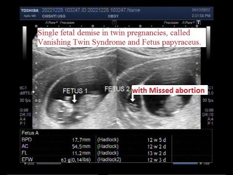 Video: Wanneer vind verdwynende tweeling-sindroom gewoonlik plaas?