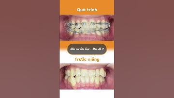 Hành trình LỘT XÁC nhờ niềng răng của Đức Thạch