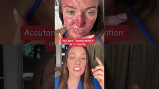 Clear Skin in 11 months on Accutane #acne