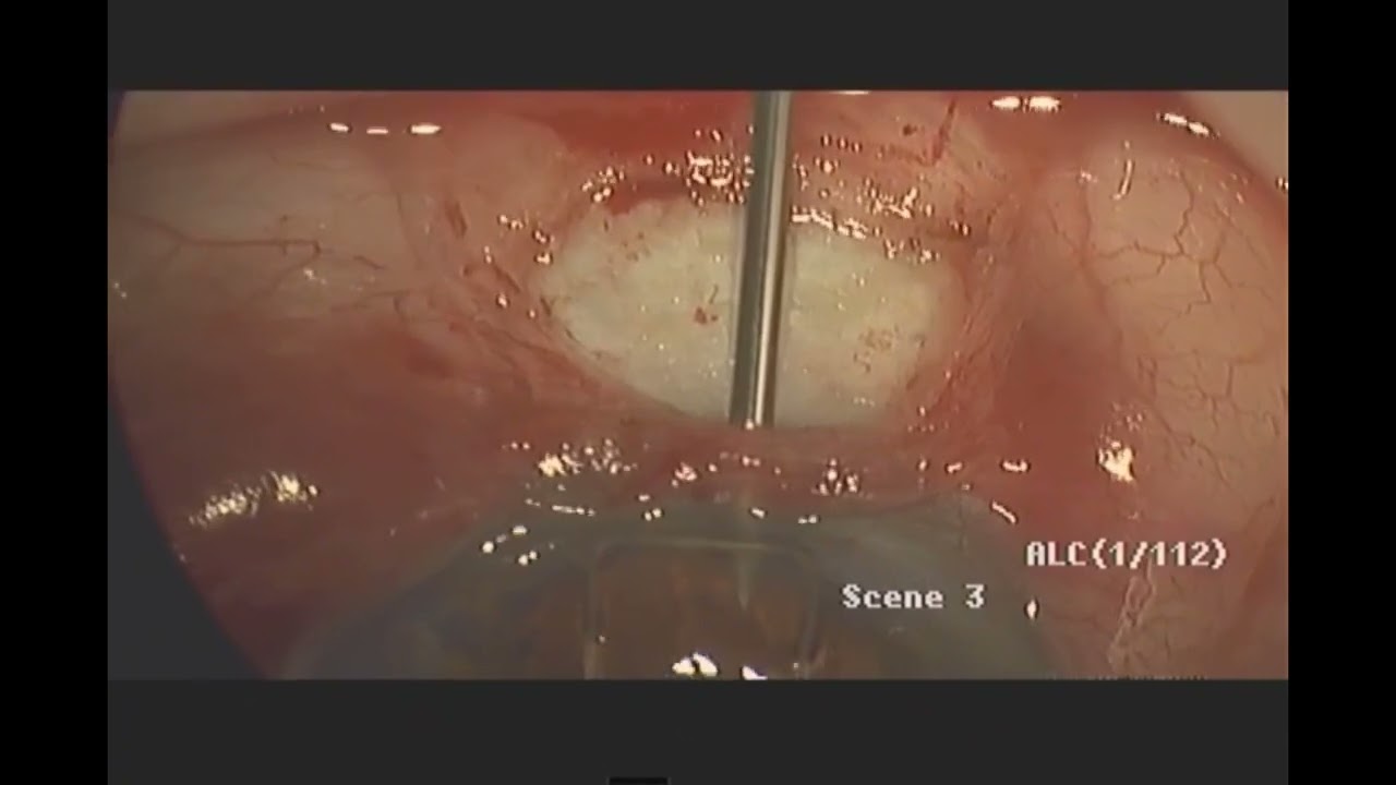 Ab-externo Placement of Xen Stent, Falck Eye Centers, LLC (Copyright 2022)