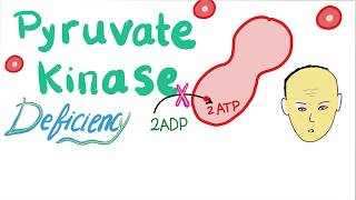 Pyruvate Kinase Deficiency Hemolytic Anemia