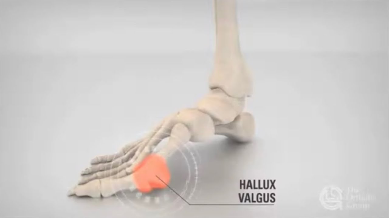 Hallux Valgus
