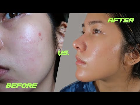 How I Cleared My Acne & Hyperpigmentation | My Differin Experience | YesStyle Skincare Haul